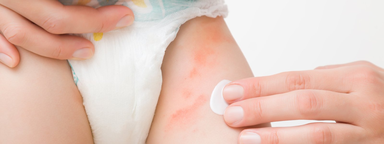 Pañalitis en Bebés: Guía de Prevención