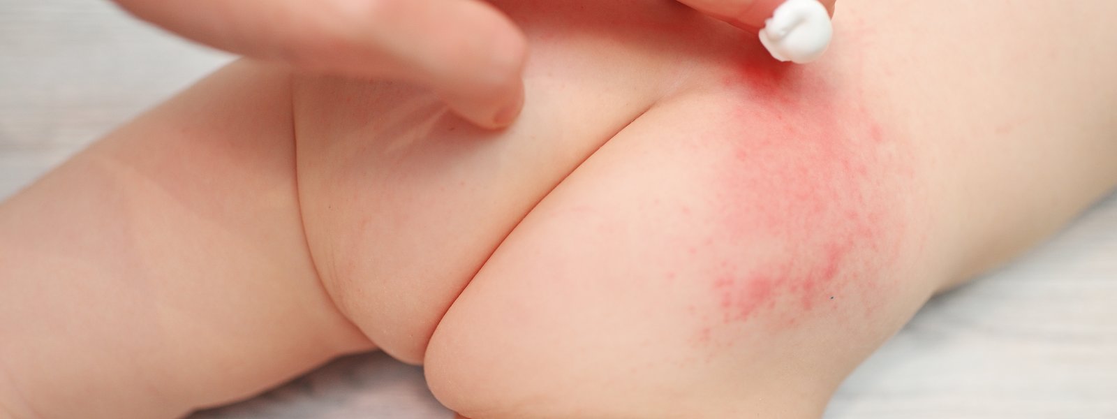 Tipos de pañalitis: conoce los síntomas y tratamiento